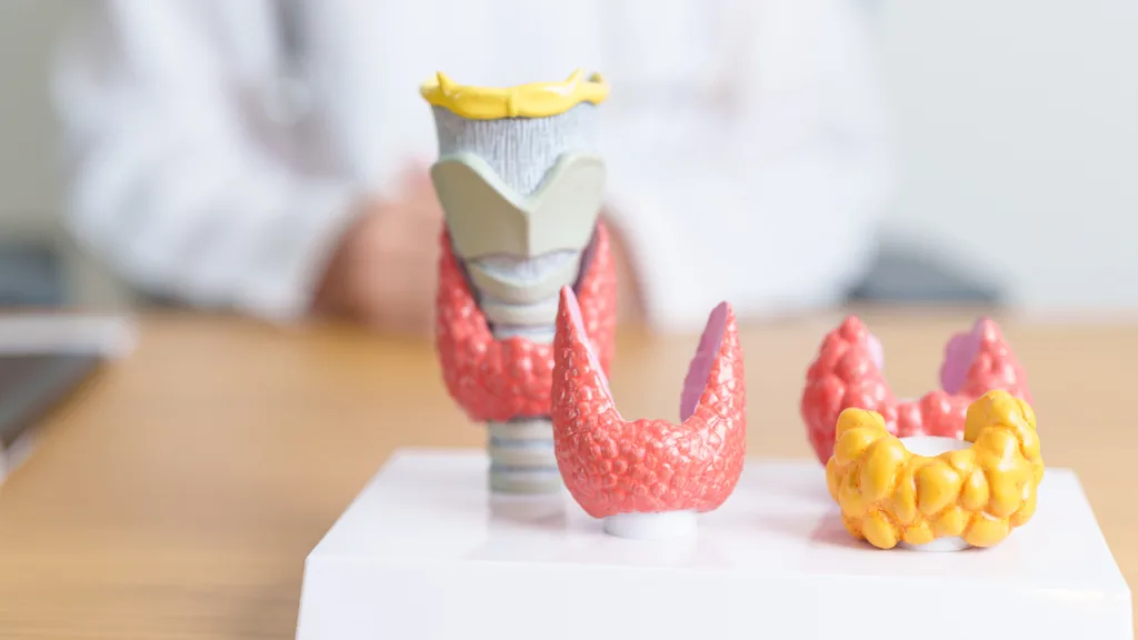 Høyt stoffskifte, hypertyreose, er en hormonsykdom skyldes økt produksjon av hormoner i skjoldbruskkjertelen.