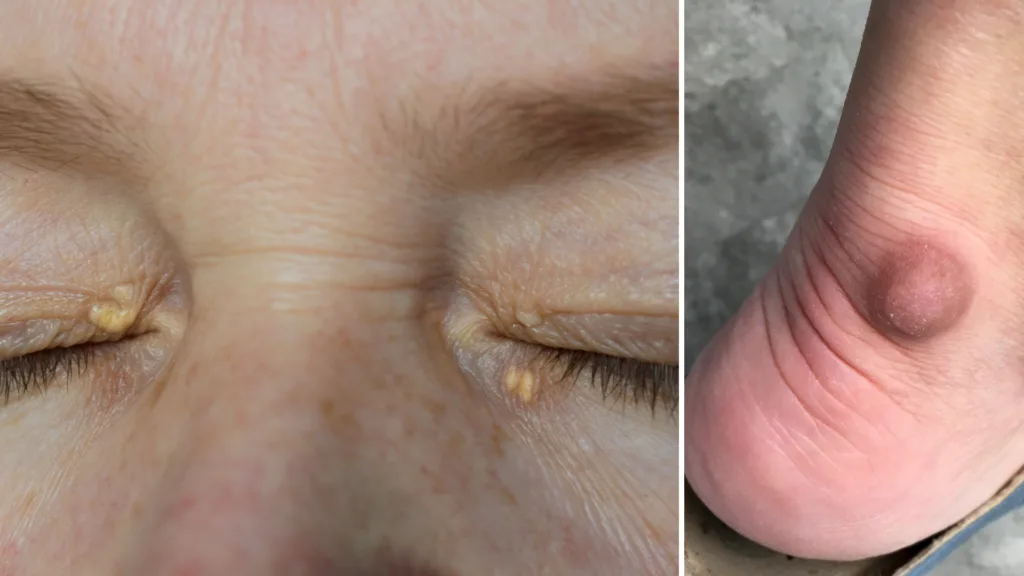 Ved betydelig høye nivåer av triglyserider kan det oppstå fettkuler i hud og senere, såkalte xanthomer og xanthelasmer.