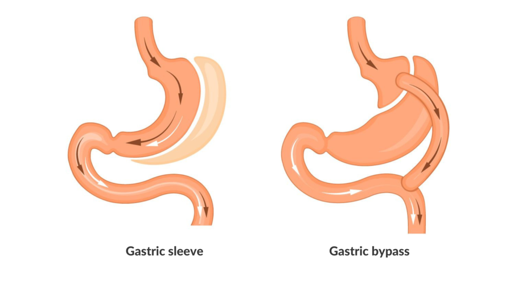 I dag utføres i hovedsak to typer vektreduserende operasjoner; gastric bypass og sleeve gastrektomi.
